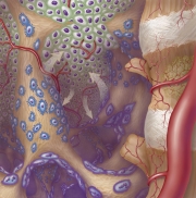 Bone tumor interaction with osteoblasts and osteoclasts