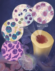 Hematological malignancies